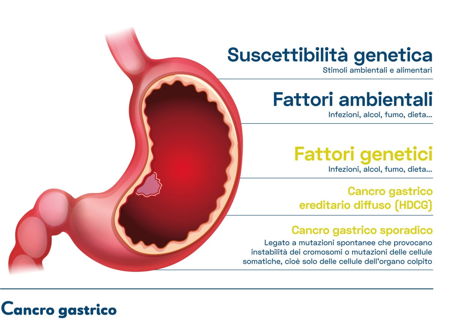 Adenocarcinoma gastrico diffuso ereditario | Fondazione Mutagens